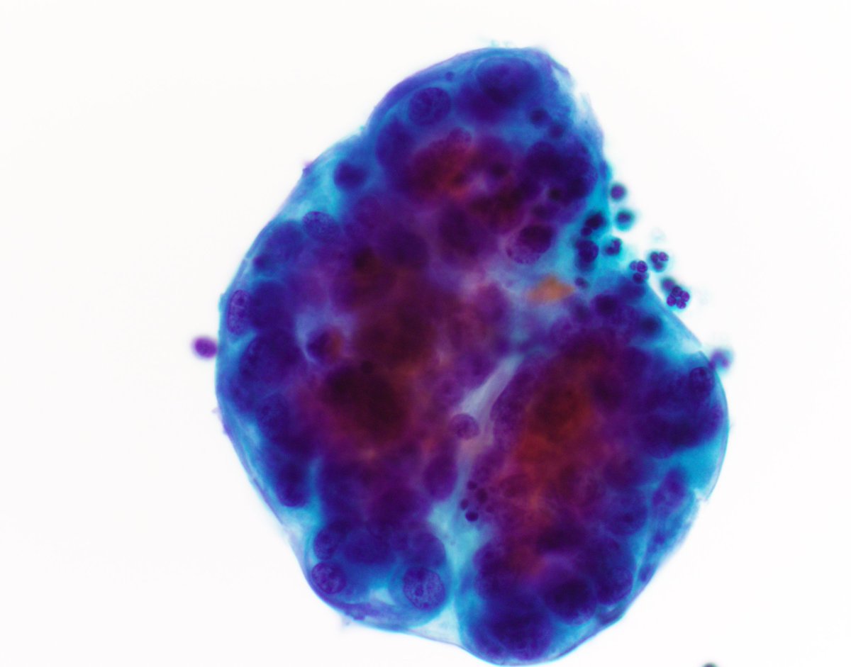 VandaTorousMD's tweet photo. For #FluidsFriday
Pleural fluid in a pt w hx colonic adenoca w signet ring cell and mucinous features - ThinPrep & CB shown here nicely highlighting the morphology
#CytoPath #PathTwitter https://t.co/Aj4chOSg2z