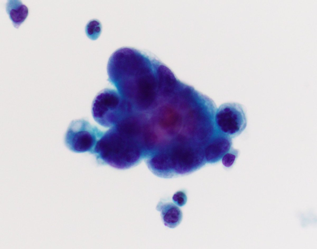 VandaTorousMD's tweet photo. For #FluidsFriday
Pleural fluid in a pt w hx colonic adenoca w signet ring cell and mucinous features - ThinPrep & CB shown here nicely highlighting the morphology
#CytoPath #PathTwitter https://t.co/Aj4chOSg2z