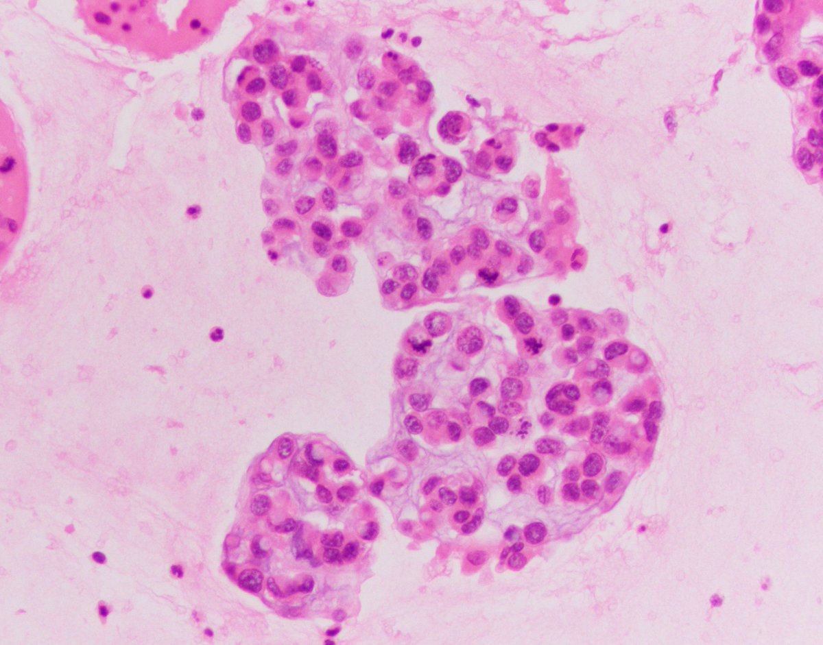VandaTorousMD's tweet photo. For #FluidsFriday
Pleural fluid in a pt w hx colonic adenoca w signet ring cell and mucinous features - ThinPrep & CB shown here nicely highlighting the morphology
#CytoPath #PathTwitter https://t.co/Aj4chOSg2z