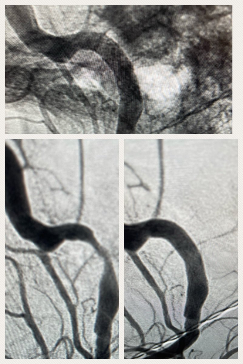 Symptomatic petrous ICA stenosis despite medical therapy. Successfully treated with balloon-mounted intracranial stenting with the Resolute Onyx system <a href="/Medtronic/">Medtronic</a>. <a href="/JeffersonUniv/">Thomas Jefferson University</a> <a href="/TJUHNeurosurg/">Jefferson Neurosurgery</a>