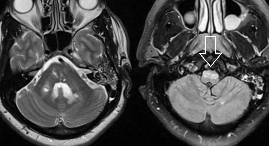 PeteFiesterMD's tweet photo. Another great #radres call! 🙂
HOD (hypertrophic olivary degeneration) related to multifocal lacunar infarcts & deafferentation of the inferior olive ⤵️
#radres #neurores #neurorad https://t.co/A7ugKtv2Sc
