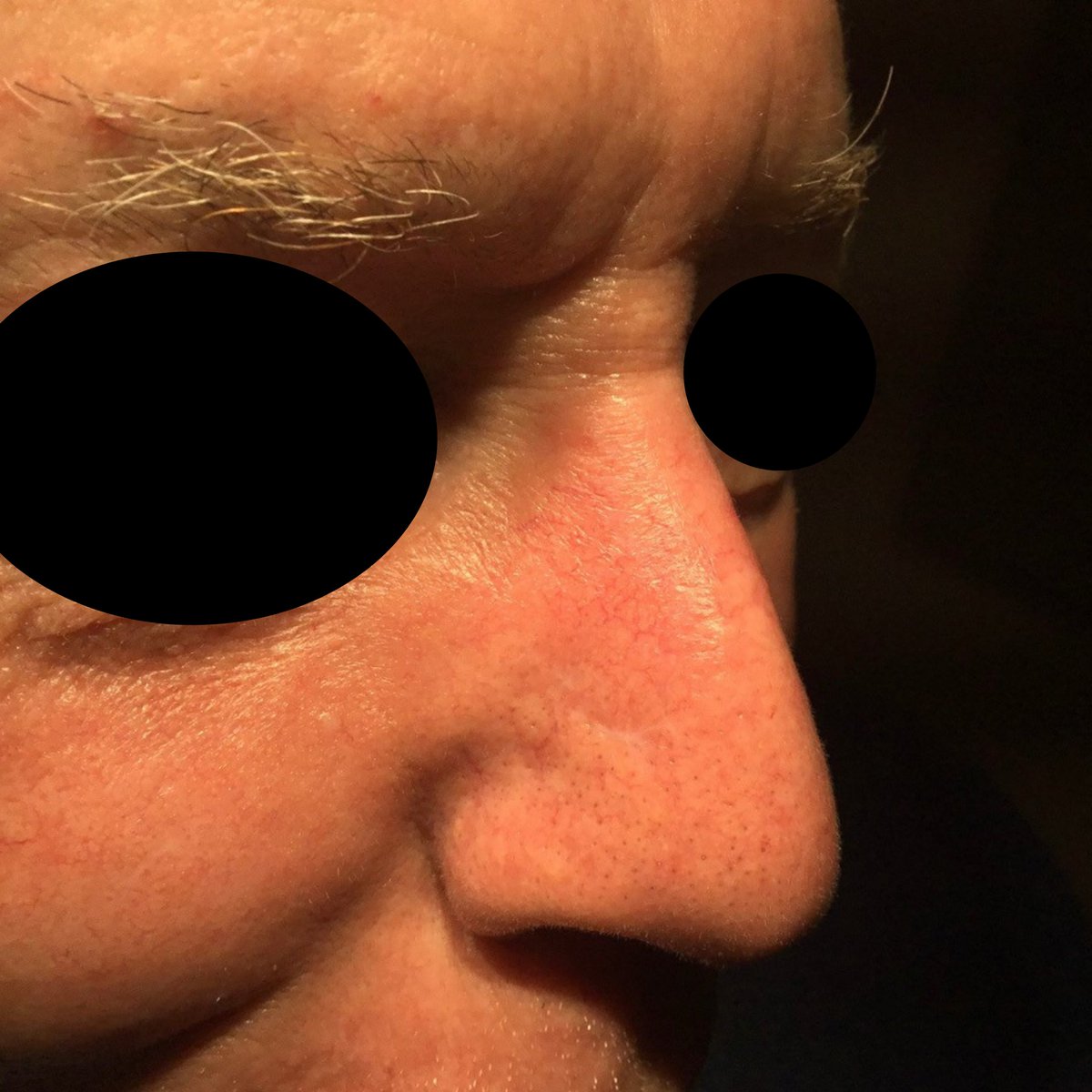 MohsCollege's tweet photo. #FlapFriday- This patient underwent Mohs surgery for complete removal of a Basal cell carcinoma. Transposition flaps offer an opportunity to recruit nearby tissue with minimal movement at the primary defect. For the upper half of the nose, the bilobed flap is a workhorse... https://t.co/6CLx8hNuR8