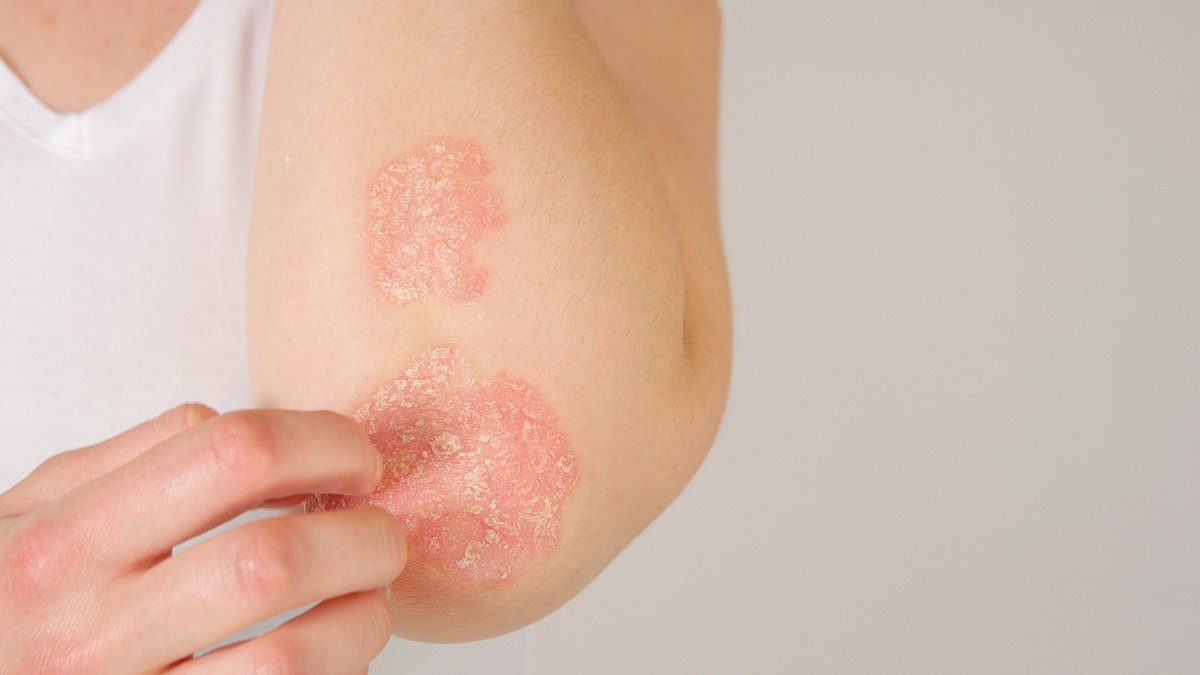 MedscapePsych's tweet image. Dr Richard Fried discusses #psoriasis, its relationship with #depression, and how to address symptoms to improve patients’ quality of life. ms.spr.ly/6013k0wnl