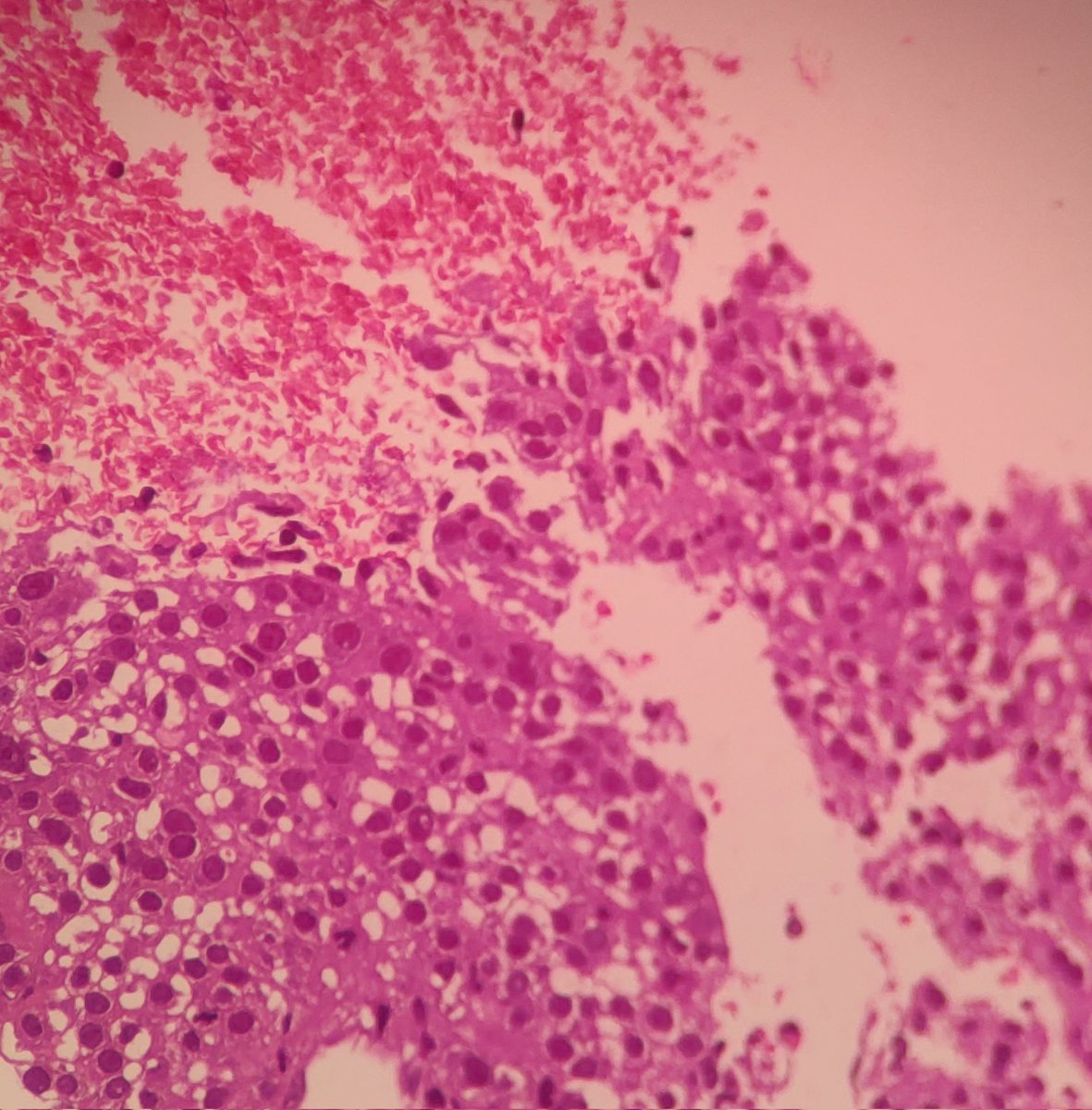 joemdoc's tweet image. #TwitterPath #Pathresidents 43/M with liver mass.
I'm I correct to screen this as a grade 2 HCC? .
👇 👇 👇