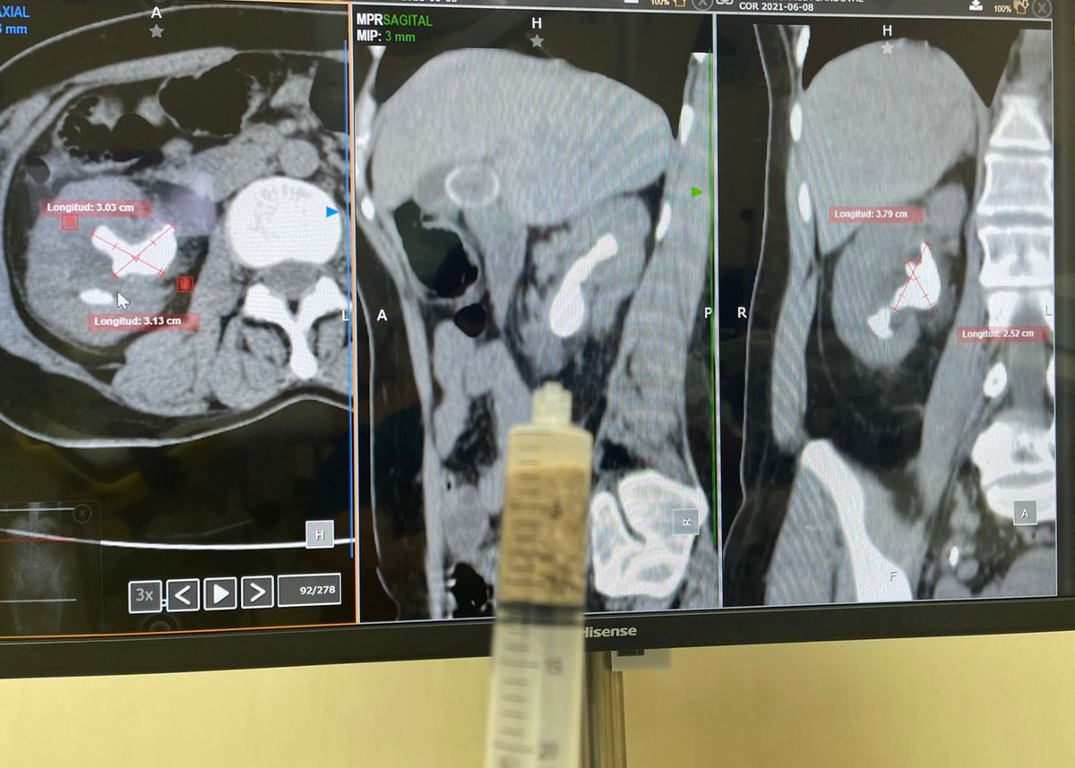 UrologoEdgar's tweet photo. SMP 14 Fr for a staghorn stone 
#stonefree #singletract the power of the suction in a reusable equipment by Hawk company 
Technic of profesor @zeng_guohua but in my hands in supine position
We are preparing a prospective study in single kidney patients https://t.co/CEudcRN5td