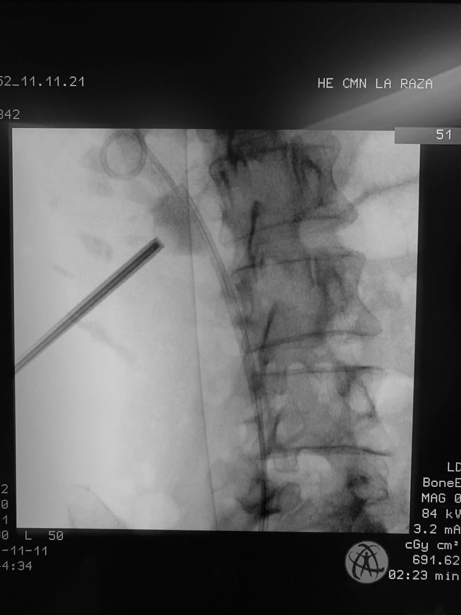 UrologoEdgar's tweet photo. SMP 14 Fr for a staghorn stone 
#stonefree #singletract the power of the suction in a reusable equipment by Hawk company 
Technic of profesor @zeng_guohua but in my hands in supine position
We are preparing a prospective study in single kidney patients https://t.co/CEudcRN5td