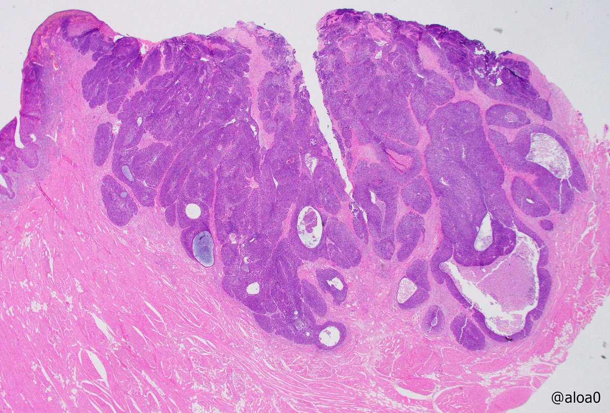 aloa0's tweet photo. Basaloid SCC, oral cavity. #ENTpath #oralpath #HNpath https://t.co/l1bvqNKV38