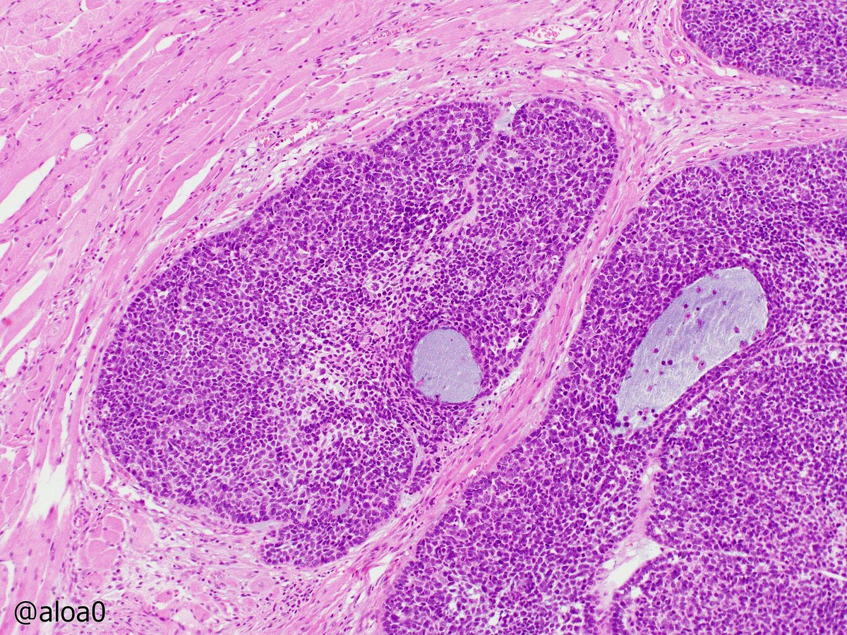 aloa0's tweet photo. Basaloid SCC, oral cavity. #ENTpath #oralpath #HNpath https://t.co/l1bvqNKV38