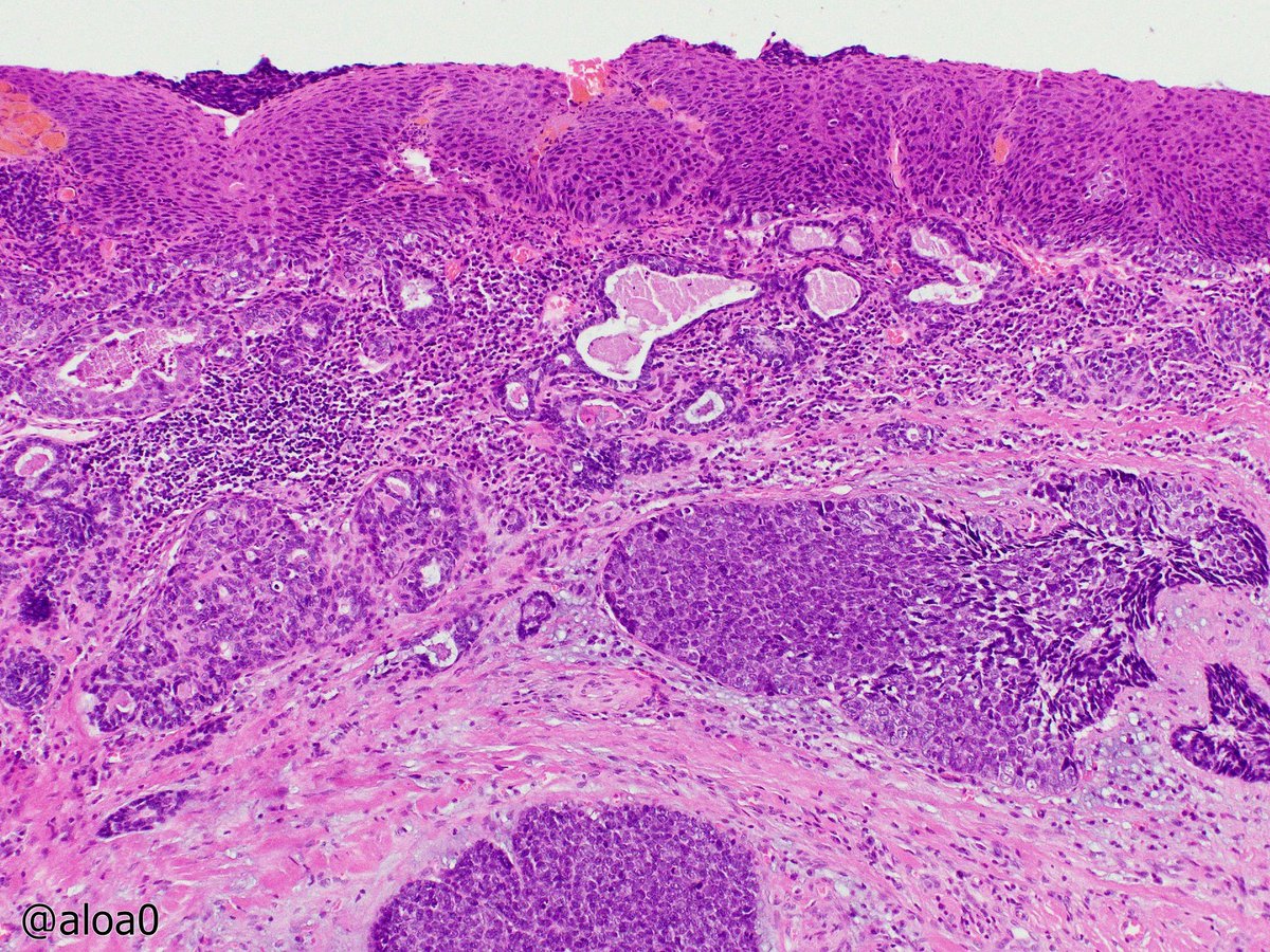 aloa0's tweet photo. Basaloid SCC, oral cavity. #ENTpath #oralpath #HNpath https://t.co/l1bvqNKV38