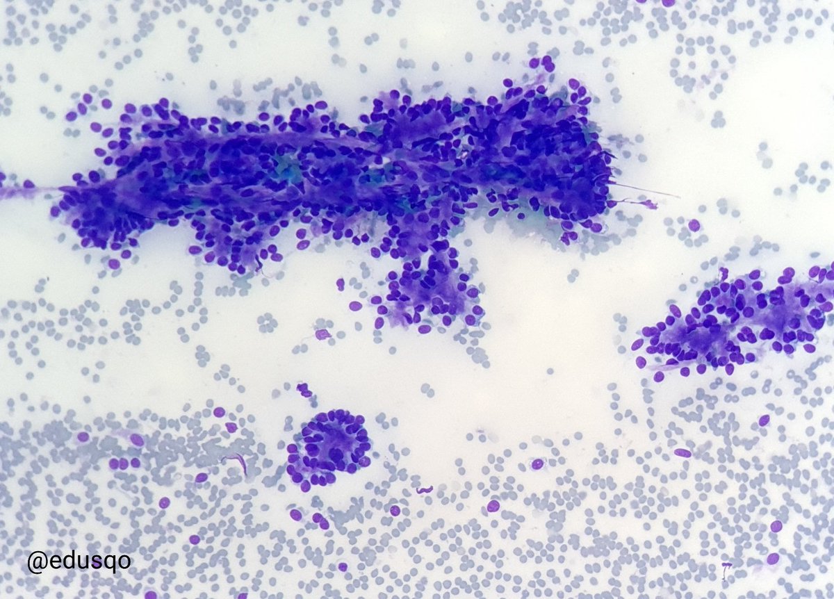 edusqo's tweet photo. Yesterday I was late 😅!
#FNAFriday on Saturday.
Suspicious for basal cell adenoma.
Category IVB (SUMP) #MilanSystem
#Cytopath #DiffQuik #ENTPath https://t.co/ypZMnblHjg
