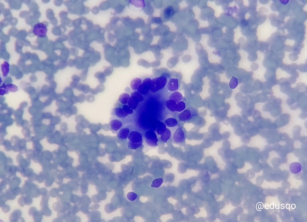 edusqo's tweet photo. Yesterday I was late 😅!
#FNAFriday on Saturday.
Suspicious for basal cell adenoma.
Category IVB (SUMP) #MilanSystem
#Cytopath #DiffQuik #ENTPath https://t.co/ypZMnblHjg