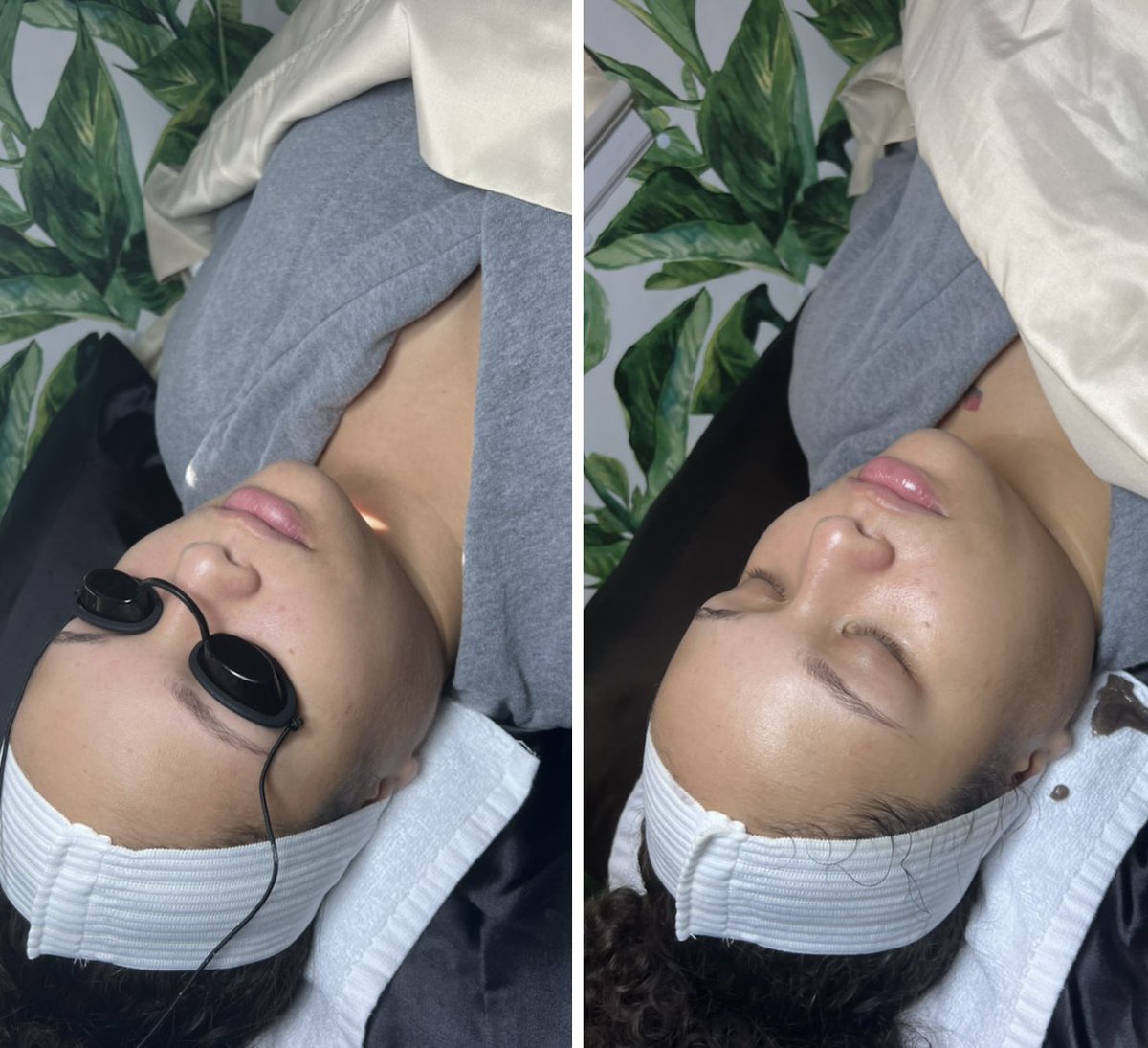 Before &amp; After Diamond Tip Microdermabrasion ✨