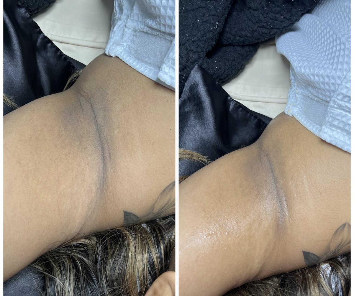 Before &amp; After 1 session of Underarm Detox &amp; Brightening Treatment ✨