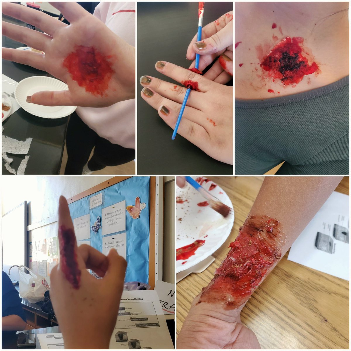 Learning about wounds and healing by creating models on themselves. I absolutely love my students. They're amazing and so creative!

#teachinganatomy #anatomyclass #Integumentarysystem