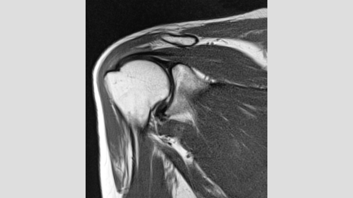 rileywilliamsMD's tweet photo. Researchers share their findings on how the MRI has excellent reliability and good specificity and accuracy in detecting the comma sign in #subscapularis tears. https://t.co/dLXtvNQ5xb #rotatorcuff #medtwitter https://t.co/1Ew2q59ytK