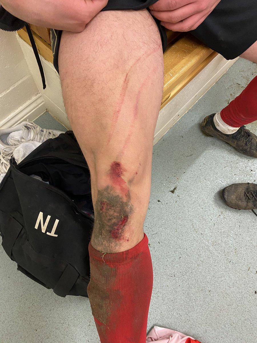 OrwellReserves's tweet photo. 1. We progress onto the next round after winning on penalties. Bare 11 today due to injuries. Our GK @OCharlesworth1 saving pens and scoring the winner! 🔥 Another @TaylorNewman07 battle wound 🤨. THE O’S GO MARCHING ON⚫️⚪️ https://t.co/hfW9OkXf4j