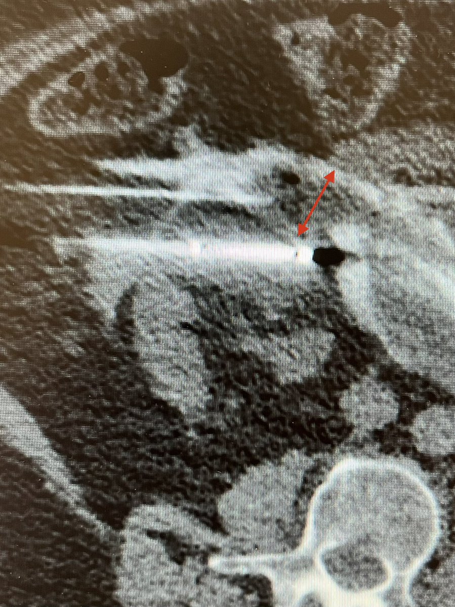 Anterior renal mass abutting small bowel. Ablation declined by outside IR due to location. Bowel displaced with hydrodissection for safe cryoablation. Thx for the tips in <a href="/ajgunnmd/">AJ Gunn</a>’s <a href="/SIR_ECS/">SIR ECS</a> recent webinar. <a href="/dotter_IR/">The Dotter Institute</a> <a href="/bostonsci/">Boston Scientific</a>
