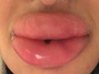 TheodoreSevil14's tweet photo. Pic of my lips only 10 MINUTES after touching my grips. Thought i was in the clear but then my son called me a "hideous monster." never before have i been so humiliated. Ive been left with agony and suffering and most likely a long lasting medical condition. Its terrifying. https://t.co/2UmPnkbBcd