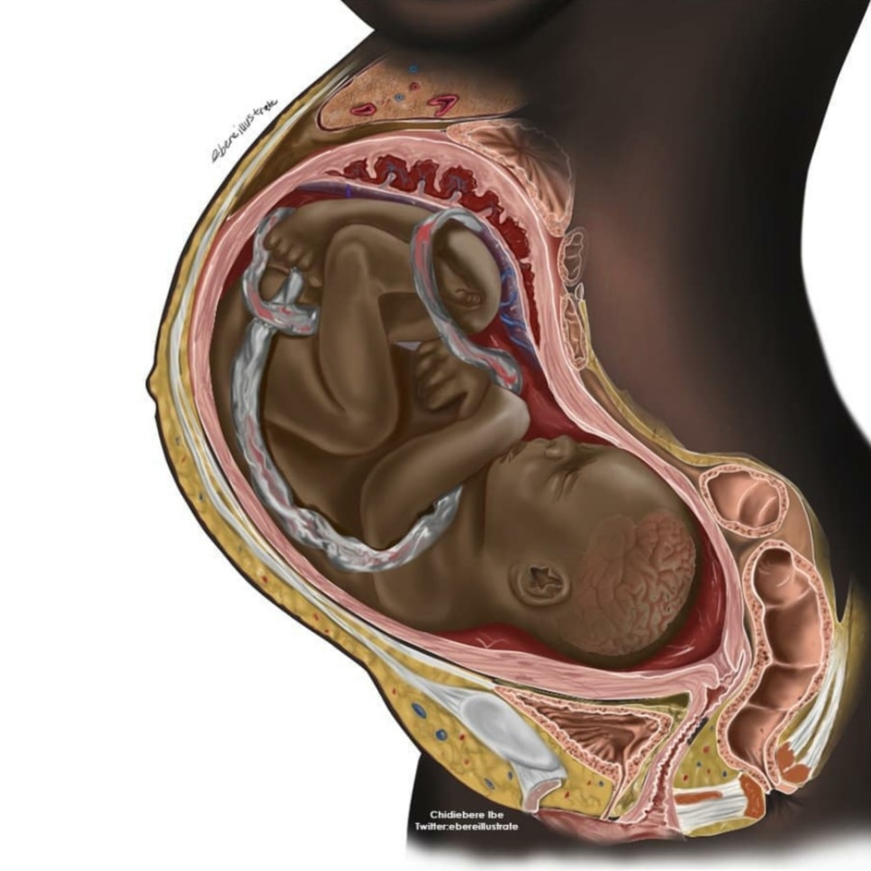 I can't recall ever once seeing a Black mother or fetus depicted in reproductive health materials. Please check out @ebereillustrate on Instagram for more racially diverse medical illustrations. #obstetrics #gynecology #reproductivehealth #medtwit