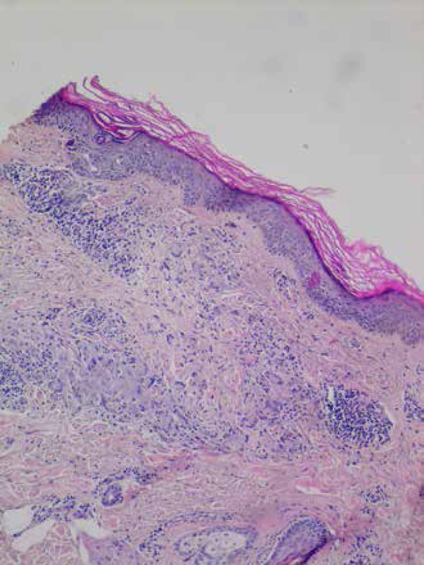 #Pathology article of the day. #AotD
Topal 2016 'Coexistence of granuloma annulare and chronic spontaneousurticaria*' #dermpath ncbi.nlm.nih.gov/pmc/articles/P…