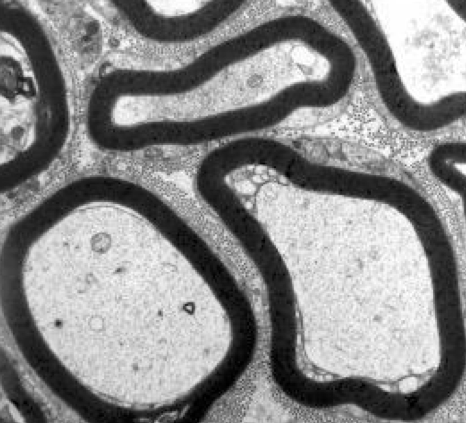 GeneTherapy_SN's tweet photo. Online now, @OSUWexMed researchers develop a large pre-clinical animal model of #SMA with #shRNA directed to the Smn gene using an #AAV9 #genedelivery system in utero. Access #GTArticle here➡️https://t.co/uJpxkfLtRr
📸: EM image of newborn ventral roots https://t.co/GNhBaOlbiX