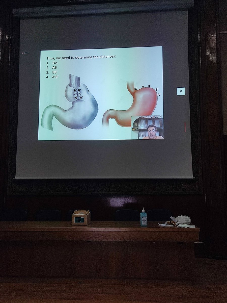 MarcosBruna_'s tweet image. Do you like maths 🎰🔢 and esophagogastric Surgery🔪🔪? Prof. Kalpesh Jani has found the solution👏 Showed at @RN27cir_EG_AEC @AEC_CEG @aecirujanos @ISDE_net @gsalcedoca @MariaPosGlez How to perfom a perfect mathematical Nissen fonduplication🧐🧐