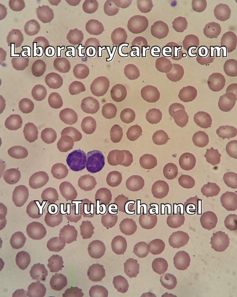 lab_career's tweet image. CHRONIC LYMPHOCYTIC LEUKEMIA (CLL) under the scope is a common finding for Medical Lab Scientists to discover. 
youtu.be/5QMZ9gqhAmo
#medicallabscientist #medicaltechnologist #clinicallabscience #cls #medicallabscience #medicaltechnology