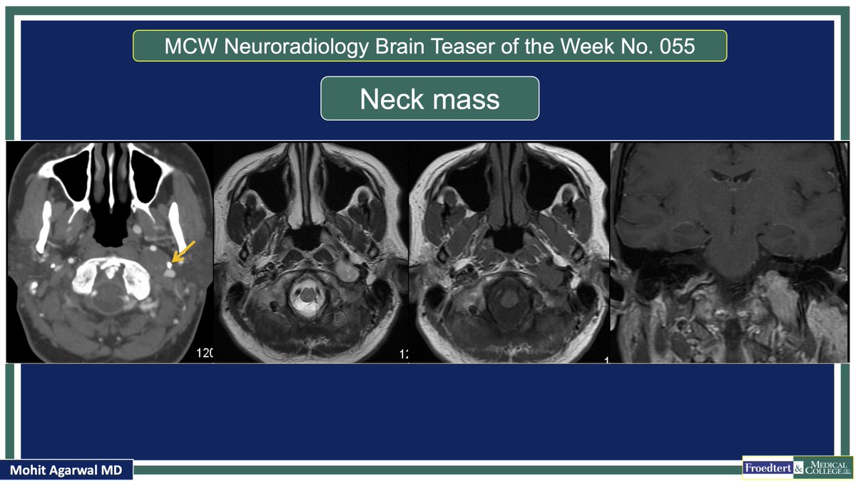 PublishedXPrime's tweet image. #MCWNeuroradBTW 055 Ans: Vagal Schwannoma

Check out #TeachingMoment on Carotid space anatomy 

#FOAMed #FOAMrad #radres #MedEd @TheASNR @ARRS_Radiology @BSHNI_UK @ESNRad @BshniTrainees @ESHNRSociety @RadDiscord @MCWRadIntGroup @MCWNeurorad @RamVaidhyanath @ASHNRSociety @TLHM_MD
