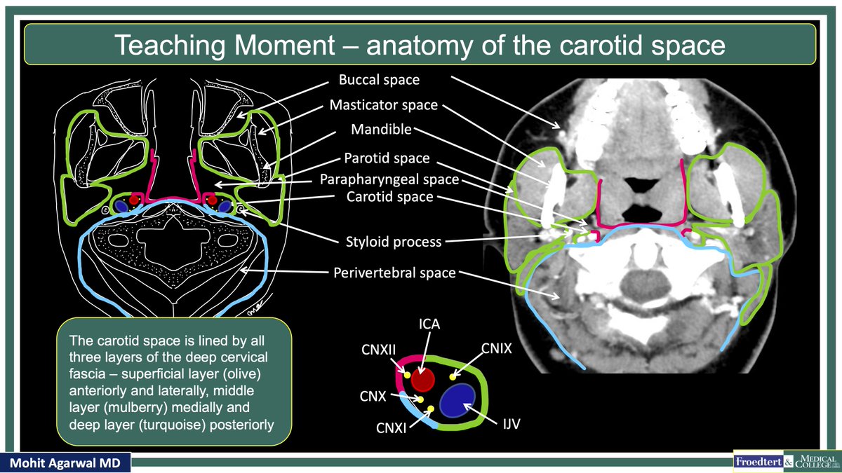 PublishedXPrime's tweet image. #MCWNeuroradBTW 055 Ans: Vagal Schwannoma

Check out #TeachingMoment on Carotid space anatomy 

#FOAMed #FOAMrad #radres #MedEd @TheASNR @ARRS_Radiology @BSHNI_UK @ESNRad @BshniTrainees @ESHNRSociety @RadDiscord @MCWRadIntGroup @MCWNeurorad @RamVaidhyanath @ASHNRSociety @TLHM_MD