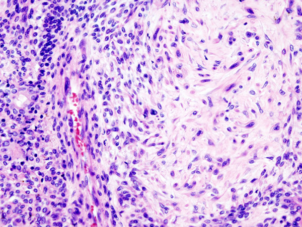 HistologyHome's tweet photo. On histology, we can expect to see hyper-cellular regions with epithelial and myoepithelial cells and hypo-cellular regions primarily composed of hyalinized stroma.
#PathCorrelate
15/15 https://t.co/LC0xBrSyXW