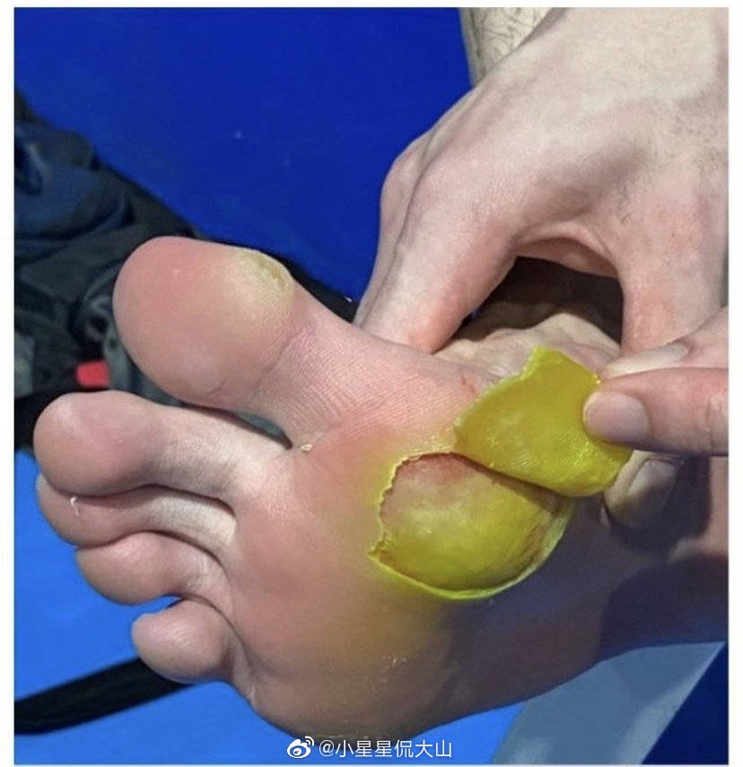 xing_is_sun's tweet photo. This is Lee Zii Jia's foot condition. Such a painful blister, it's all peeled off. For all those people who mock Zii Jia today, fight me!😠 #BWFWorldChampionships2021 https://t.co/JuarXnGm15