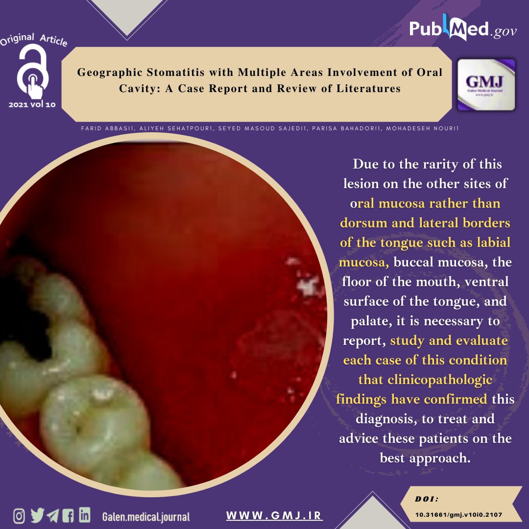 galenjournal's tweet photo. .
⭕Geographic Stomatitis with Multiple Areas Involvement of Oral Cavity: A Case Report and Review of Literatures
⭕Read this article at:
https://t.co/aGc8gKpbHG
.
#Geographic_Stomatitis #Geographic_Tongue #Oral_Mucosa https://t.co/e8dWanfRJu