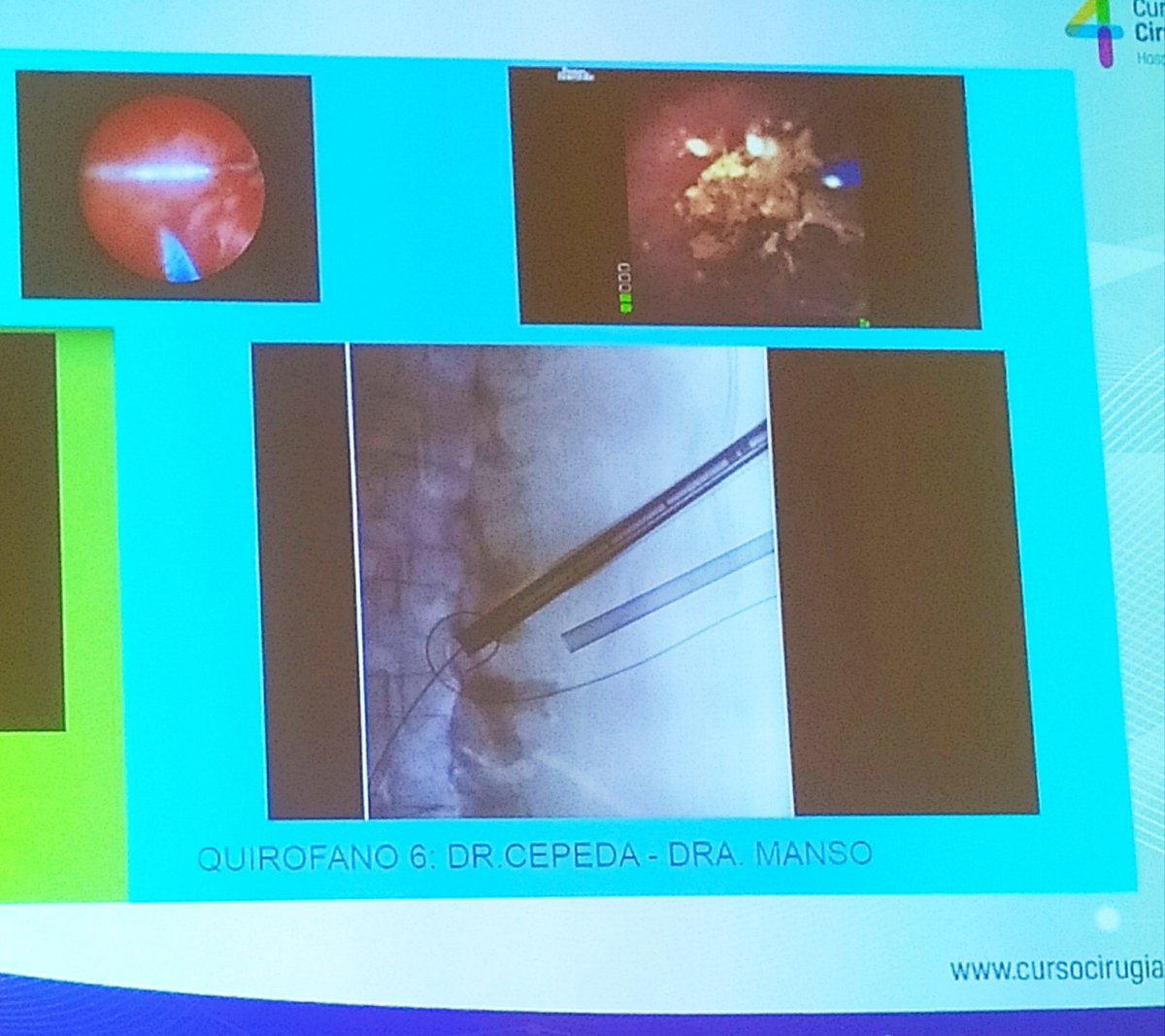 Emocionante charla final del Dr. José H. Amón en #endouroHURH 
Orgulloso de la aportación maña en la Endourología <a href="/ValdiviaUria/">José Gabriel Valdivia Uría</a> #supinePCNL
Gran aprendizaje estos días #urosome #endouro