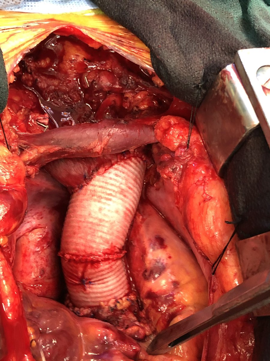 Sarah Ward Palmer, MD (@sarah_wardct) on Twitter photo Another type A dissection in the books with <a href="/BoYangMD/">Bo Yang</a> “Michigan Style” -
no felt, no bioglue, no pledgets (and no transfusions 🩸) Great mentor with superb technique <a href="/UMichCTSurgery/">Michigan CT Surgery Residency</a> <a href="/UMichSurgery/">Michigan Surgery</a> <a href="/GAilawadiMD/">Gorav Ailawadi</a> Another type A dissection in the books with <a href="/BoYangMD/">Bo Yang</a> “Michigan Style” -
no felt, no bioglue, no pledgets (and no transfusions 🩸) Great mentor with superb technique <a href="/UMichCTSurgery/">Michigan CT Surgery Residency</a> <a href="/UMichSurgery/">Michigan Surgery</a> <a href="/GAilawadiMD/">Gorav Ailawadi</a>
