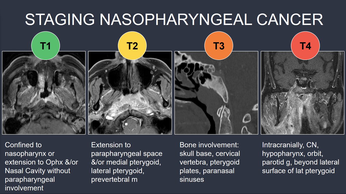 Today <a href="/UWiscNeuroRad/">University of Wisconsin Neuroradiology</a> we finished up the H&amp;N cancer series with a review of Nasopharyngeal Cancer. 

For NPC, think EBV rather than HPV (Oropharynx)

Tumor staging depends on sites of invasion, not size

Nodes below the cricoid = N3 disease

DDx: NPC, lymphoma &amp; skull base osteo