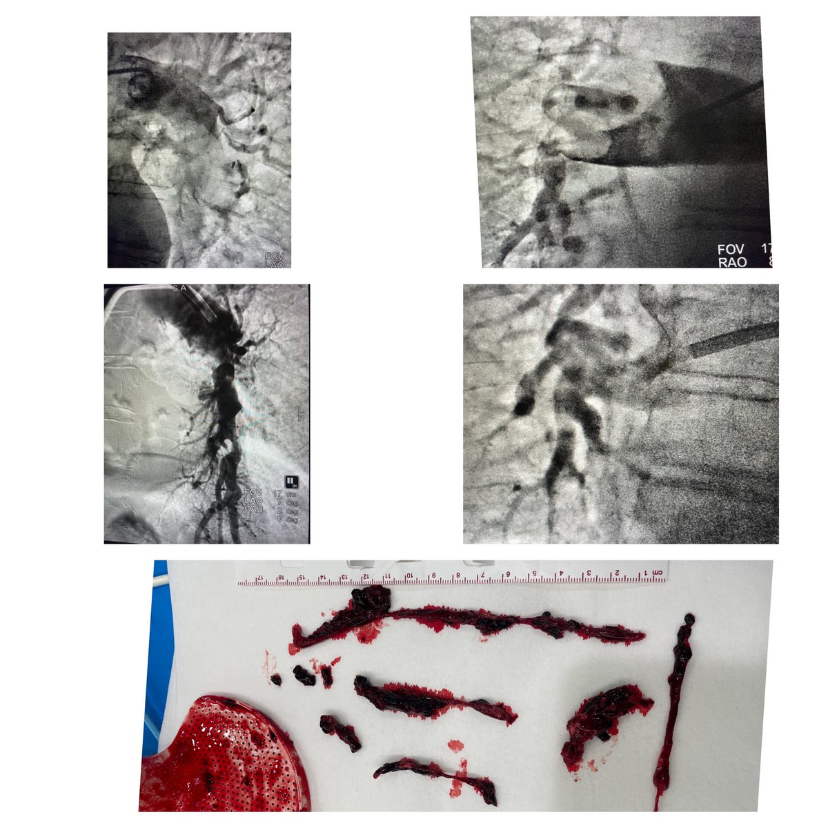 Cooper IC Fellowship (@ic_cooper) on Twitter photo Great case this week. From the ED, submassive PE with class IV PESI. RV blown out with ratio 1.6. ER to Cat 12 2 hours, 95% RA and Normal RV next day. #pert #clotbuster #StrikePE <a href="/PenVascular/">Penumbra Vascular</a> @CardiacPartners <a href="/CooperCVFellows/">Cooper Cardiology Fellows</a> <a href="/MonicaPerla4/">Monica Perla</a> Great case this week. From the ED, submassive PE with class IV PESI. RV blown out with ratio 1.6. ER to Cat 12 2 hours, 95% RA and Normal RV next day. #pert #clotbuster #StrikePE <a href="/PenVascular/">Penumbra Vascular</a> @CardiacPartners <a href="/CooperCVFellows/">Cooper Cardiology Fellows</a> <a href="/MonicaPerla4/">Monica Perla</a>