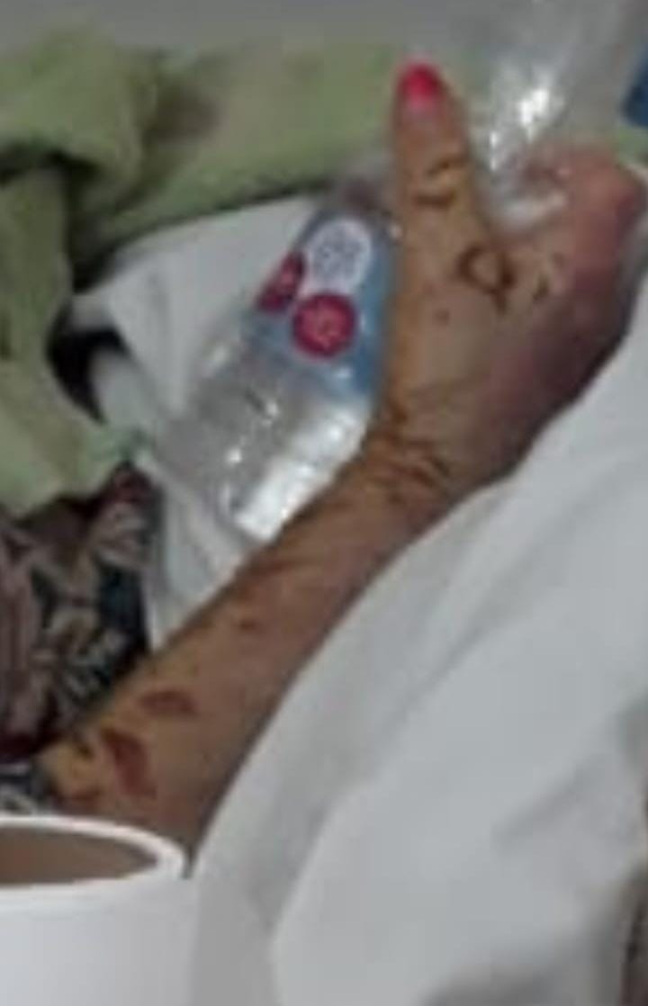 CrisCastello01's tweet photo. 1.-Tengo fotos de 1 Sra. internada en Sanatorio Concordia de Concordia, E Ríos.
Luego de las 2 vacunas le quedó todo el cuerpo así.
Tiene olor nauseabundo. XA bañarla, deben untarla con vaselina; y se le cayó el cabello.
Hay 7 casos iguales  en la misma ciudad
Envío sólo 1 foto. https://t.co/aNZ5Z7oWDf