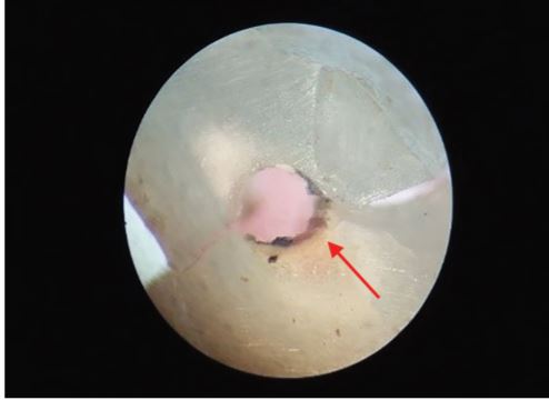 JaypeeBrother's tweet image. Stereomicroscopic Evaluation of Fiber Post Failure Modes after Use of Three Different Endodontic Sealers: An In Vitro Study
jodend.com/doi/JODE/pdf/1…

#EndodonticSealer #Fiberpost #ResinCement #Endodontics #OperativeDentistry #JODE #KavithaM #CEAT #JaypeeJournals #RagaviShanmugam