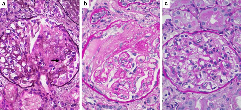 Antineutrophil Cytoplasmic Autoantibody–Associated Glomerulonephritis Following the Pfizer-BioNTech COVID-19 Vaccine. 2021 from <a href="/KIReports/">KIReports</a> 

➡️ kireports.org/article/S2468-… #COVID19 #CovidVaccine