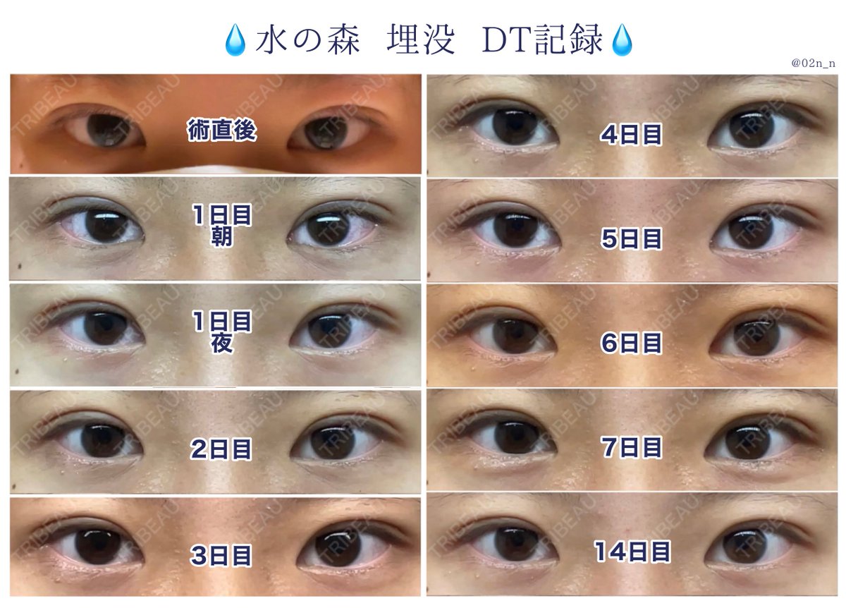02n_o's tweet photo. 昨日でダウンタイム終了しました〜〜❗️

初めの1週間と14日目を画像にまとめましたので、これから埋没を考えている方の参考になれば幸いです✧︎*。

リプ欄にbefore繋げます😌

#埋没 #二重埋没 #埋没経過 #埋没レポ #水の森 #整形垢さんと繋がりたい https://t.co/ggIv3ynhrN