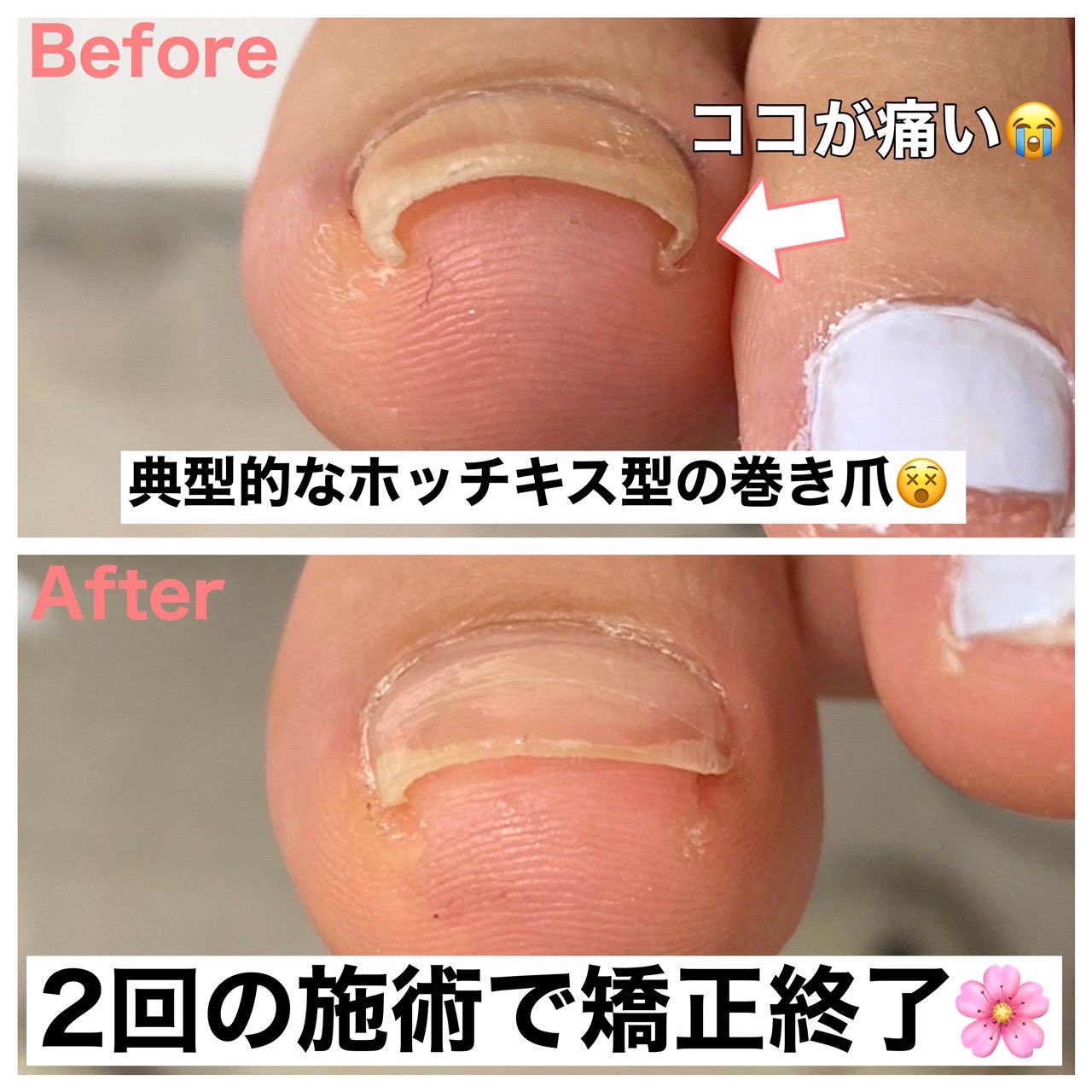 巻き爪サロン Libre Makizumelibre Twitter