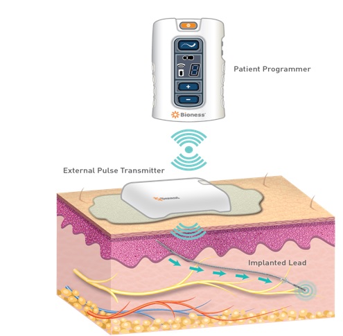 primneuromod's tweet photo. Al contrario que otras opciones, #StimRouter es una intervención sencilla y mínimamente invasiva.
🔝 No se implanta ningún generador.
🔝 El paciente controla su propio tratamiento, puede apagar o recibir la estimulación según su criterio.
#vejigahiperactiva #incontinencia https://t.co/F0sph8jbNf