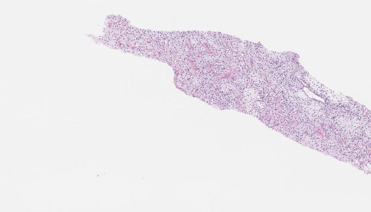 B_C_Dickson's tweet photo. MYXOID LIPOSARCOMA: NGS: EWSR1-DDIT3. NB: limited sample showing spindle-stellate cells with monomorphic ovoid nuclei; interspersed lipoblasts; myxoid stroma; prominent – slightly ectatic – anastomosing thin-walled vessels. https://t.co/z4yjCMY6A3