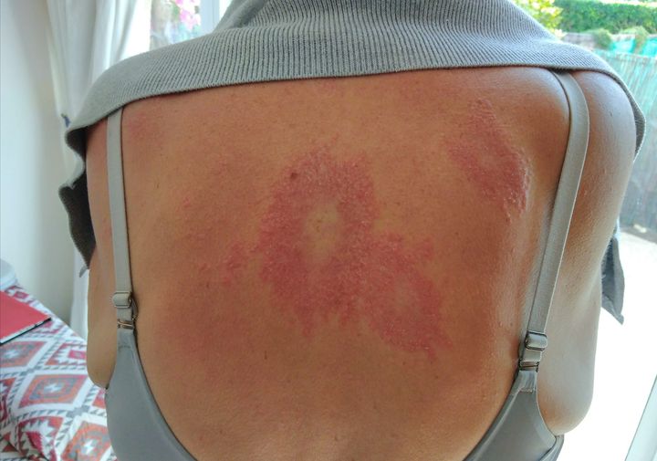 ChitkwesuManetu's tweet photo. Since September when this rash developed on my back I have been on a roller coaster of medical examinations To date have had 8 blood tests, spinal, hip & chest x-ray. I was diagnosed with Lupus but after a biopsy taken from my back it appears I have a rare disease Sarcoidosis 1/2 https://t.co/gB1BMvKDCj