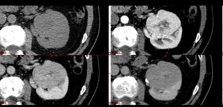 Fernando Ide Yamauchi (@nandoide) on Twitter photo Real life, 56 yo female. Centrally located hypervascular mass, unlikely for partial nephrectomy.
Who would call for a central scar? Biopsy applies?
<a href="/NickSchiedaMD/">NickSchieda</a> <a href="/hiltonmlf/">Hilton Leão Filho</a> <a href="/ivpedrosa/">Ivan Pedrosa</a> <a href="/cookyscan1/">Cooky Menias</a> <a href="/danatsouza/">Daniel Souza</a> Real life, 56 yo female. Centrally located hypervascular mass, unlikely for partial nephrectomy.
Who would call for a central scar? Biopsy applies?
<a href="/NickSchiedaMD/">NickSchieda</a> <a href="/hiltonmlf/">Hilton Leão Filho</a> <a href="/ivpedrosa/">Ivan Pedrosa</a> <a href="/cookyscan1/">Cooky Menias</a> <a href="/danatsouza/">Daniel Souza</a>