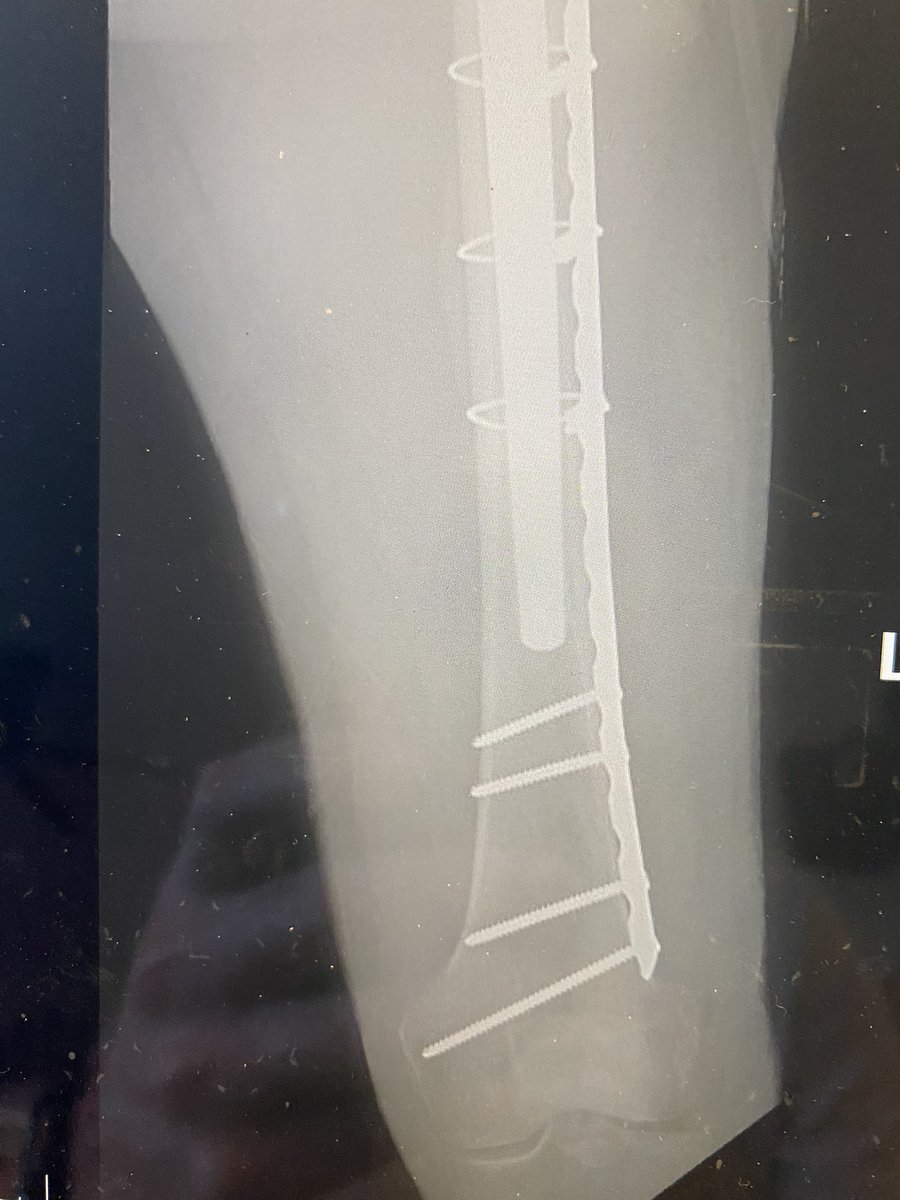 Craig Hogan (@hoganmdcraig) on Twitter photo <a href="/depurhro/">Deepu Bhaskar</a> revised plus ORIF in my hands. In older patients I have also tended to extend fixation across the entire femur for prophylactic femur protection. Pics of recent case but press fit stem. Slightly different concepts. ?anyone else prophylactic long femur fixation? <a href="/depurhro/">Deepu Bhaskar</a> revised plus ORIF in my hands. In older patients I have also tended to extend fixation across the entire femur for prophylactic femur protection. Pics of recent case but press fit stem. Slightly different concepts. ?anyone else prophylactic long femur fixation?