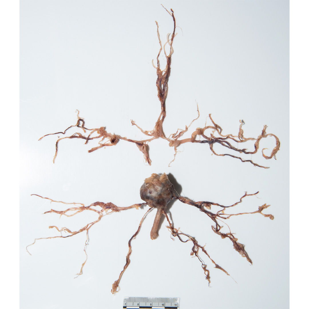 detroitsdocket's tweet photo. 3. Pictures show a fusiform aneurysm of the basilar artery.  Note the endovascular graft in the basilar artery and coiling of the aneurysm. https://t.co/XQJLZ5p5bl