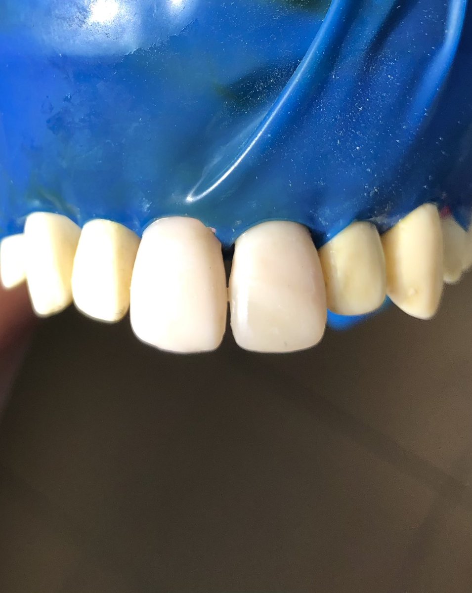 First trial class IV composite restoration for upper left central