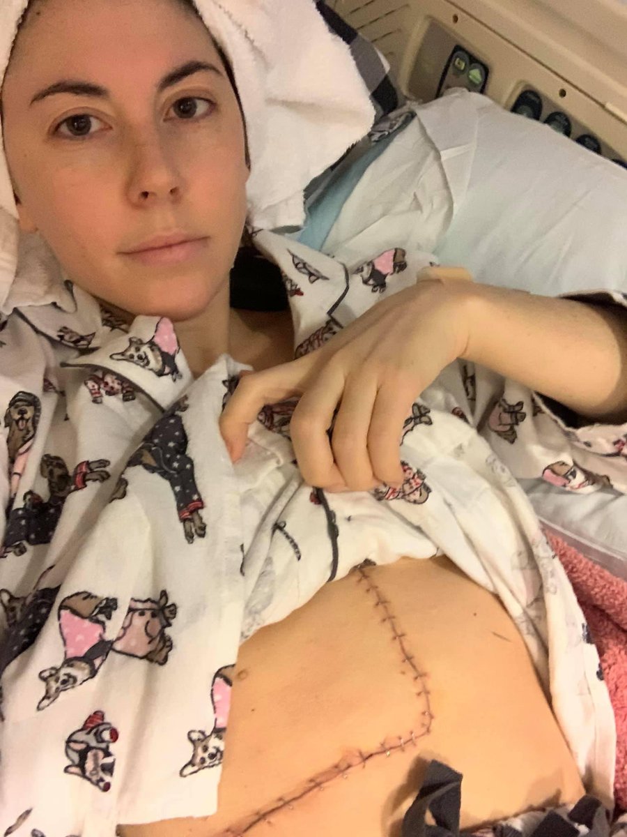AlexaMorell4's tweet photo. 2 years ago today I woke up to my 1st battle scar. Not everyone gets this chance, so I am eternally grateful to @motazqadan for saving my life.. twice! 19 + months w. a disease free liver! 💙
#surgeryversary #youngonsetcrc @DFarberYoungCRC @MassGenBrigham #NED #stage4crc https://t.co/ceY7M4Wlgx