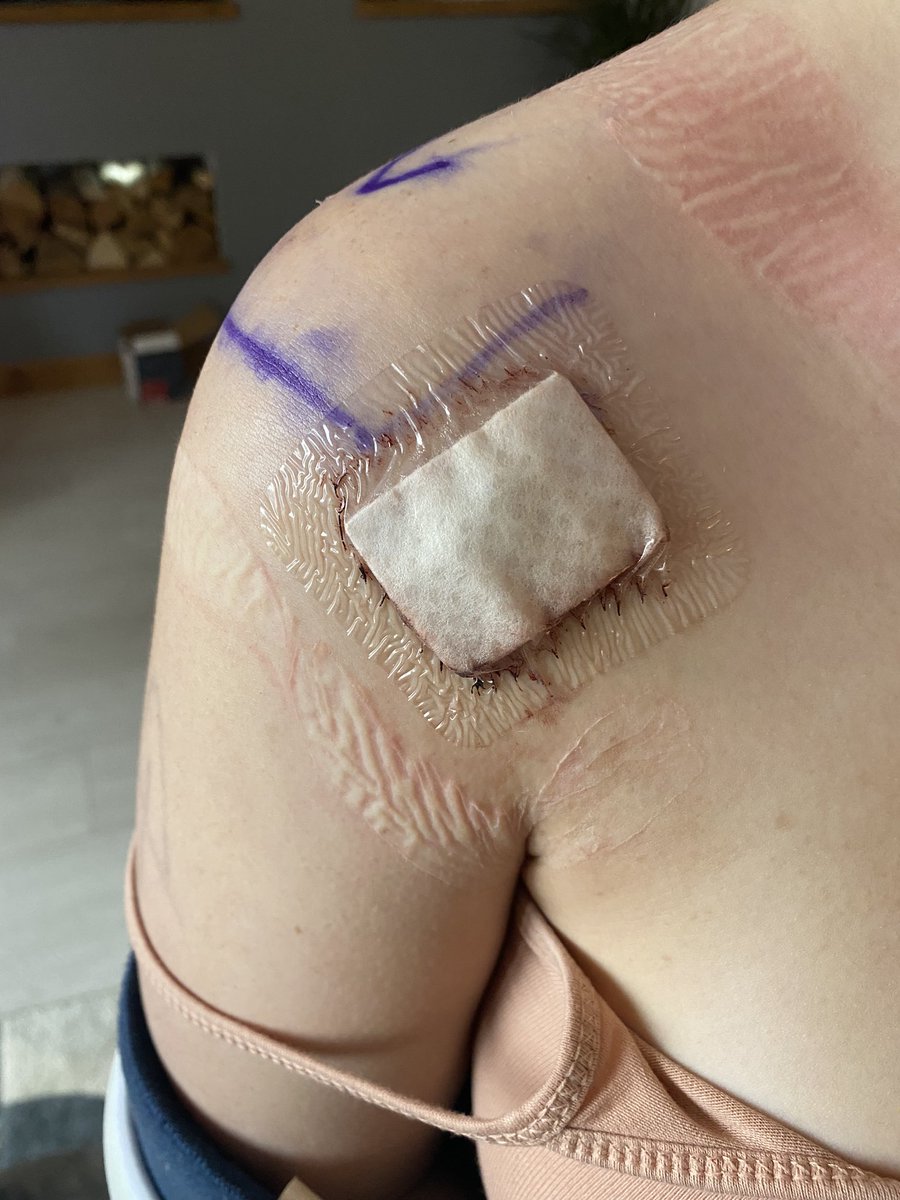 FayeBlount_'s tweet photo. so just over a week out from my shoulder surgery and i’m healing amazingly🙌🏼 first days were rough but i’m back to myself now and i’ve even got some movement!! stiches out next week and then back training around feb- ready for war later in the year🥊
•
#girlfighter #rehab https://t.co/4oooAInD29